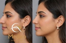 Before and After Rhinoplasty