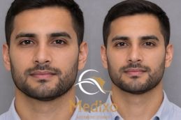 before and After male result