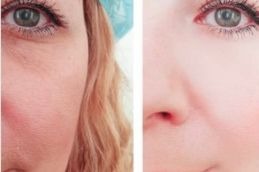 chemical peel result before and after