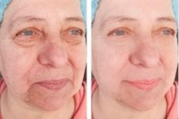 chemical peel result