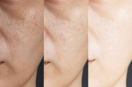 result before and after glutathione injections result