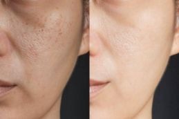 glutathione injection in islamabad