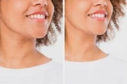 Jawline before after result islamabad