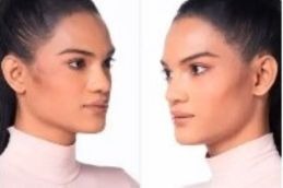 Before After Result Jawline Fillers