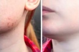 Jawline fillers result