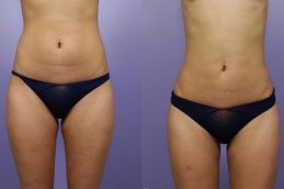 Liposuction before and after