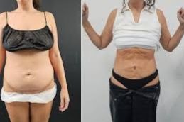 Before and after result of liposuction in Islamabad