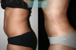 before liposuction and after Liposuction