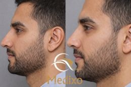 before and after male rhinoplasty