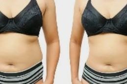 mounjaro injection before and After