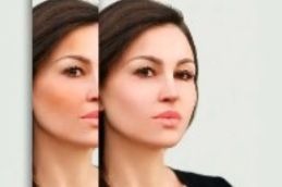 Skin Whitening in islamabad result