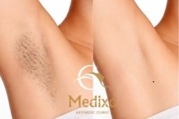 before and after result