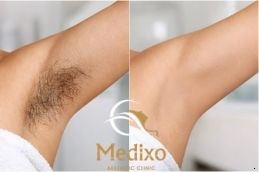 Under Arm laser hair removal in Islamabad