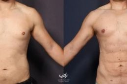 Result Liposuction