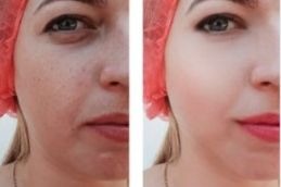 Chemical Peel before and After