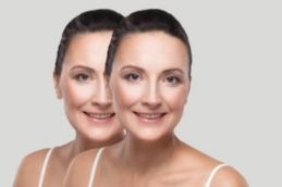 Chemical peel result in Islamabad