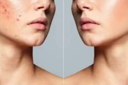 jawline before and after Islamabad Pakistan