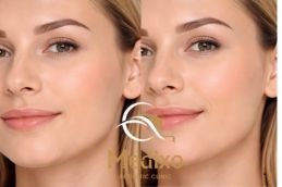 laser hair removal result before and after