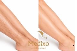 before and after result leg laser hair removal