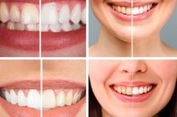 Before and after teeth whitening Islamabad