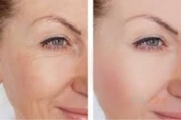 Hifu treatment result in islamabad