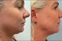 Before and After result