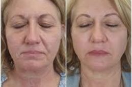 before and after result of hifu treatment