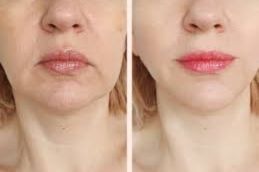 before and after treatment result