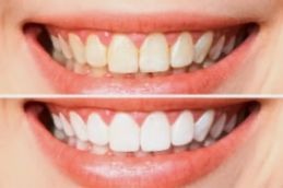 teeth whitening before and after