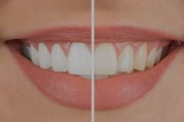 teeth whitening before and after