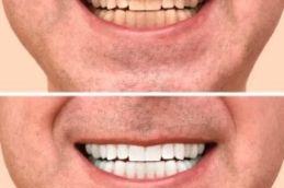 teeth whitening before and After