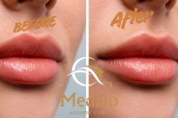 Before and After Hydrafacial in Islamabad