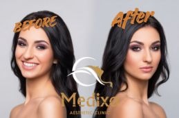 Before and After Hydrafacial treatment in Islamabad , Rawalpindi & Pakistan