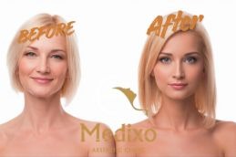 Before and After Hydrafacial treatment in Islamabad