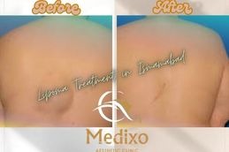 Before and After Lipoma Treatment in Islamabad &Pakistan