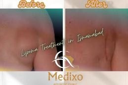 Before and After Lipoma Treatment in Islamabad &Pakistan (1)