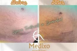 Before and After Lipoma Treatment in Islamabad , Rawalpindi &Pakistan