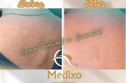 Before and After Lipoma in Islamabad , Rawalpindi &Pakistan