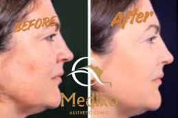 Before and After Result Hydrafacial treatment in Islamabad , Rawalpindi & Pakistan