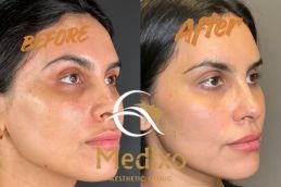 Before and After Result Hydrafacial treatment in Islamabad , Rawalpindi