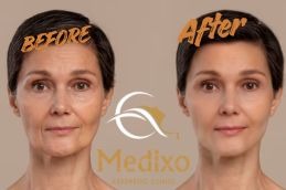 Before and After Result Hydrafacial treatment in Islamabad