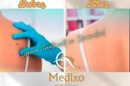 Before and After result Lipoma Treatment in Islamabad &Pakistan