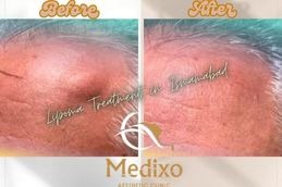 Before and After results Lipoma Treatment in Islamabad &Pakistan