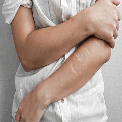 Self harm Scar Treatment in Islamabad