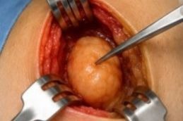 Step 2 of Lipoma Treatment in Islamabad