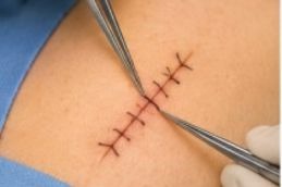 Step 3 of Lipoma Treatment in Islamabad