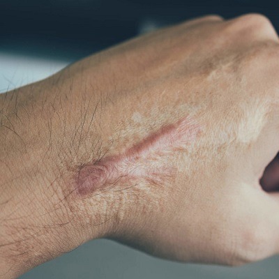 Trauma Scars Removal Treatment
