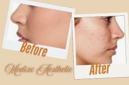before and After Atrophic Acne Scars in Islamabad