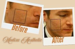 before and After Atrophic Acne Scars in Islamabad Pakistan
