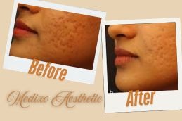 before and After Atrophic Acne Scars in Islamabad